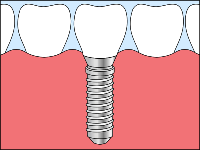 インプラント